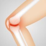 arthrocalman, osteoarthritis, knee