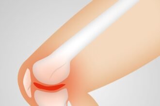 arthrocalman, osteoarthritis, knee